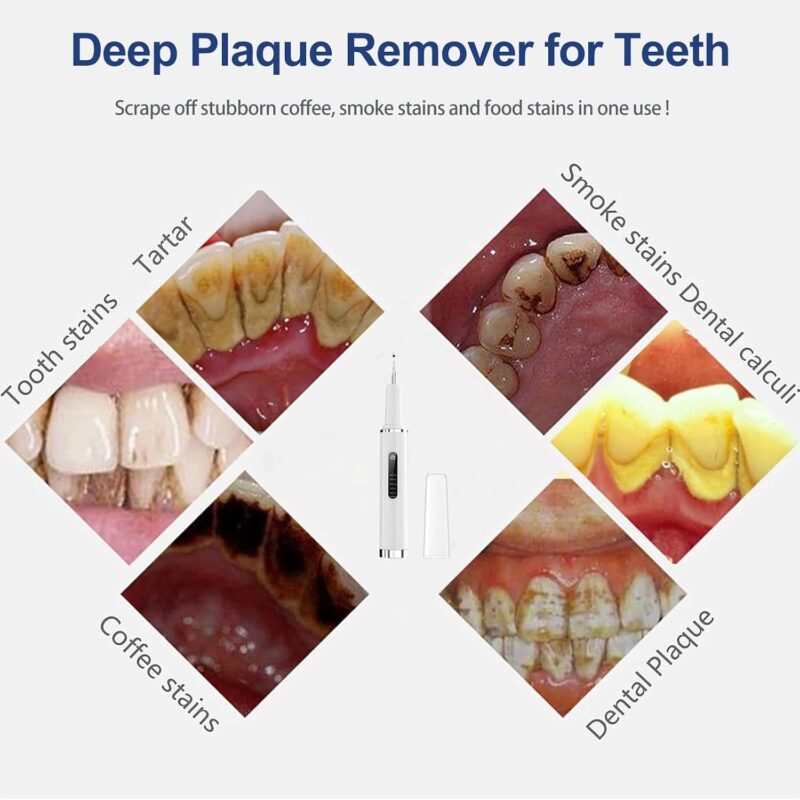 5be58384 03e0 41bb a917 2d447d961f3d professional plaque remover contact activated teeth cleaning 6 1.jpg