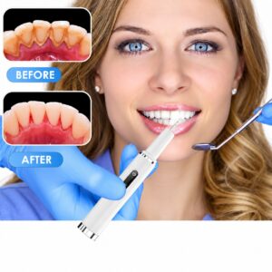 B2879cda 505d 4774 8dc8 057c26b4ba51 professional plaque remover contact activated teeth cleaning 11.jpg