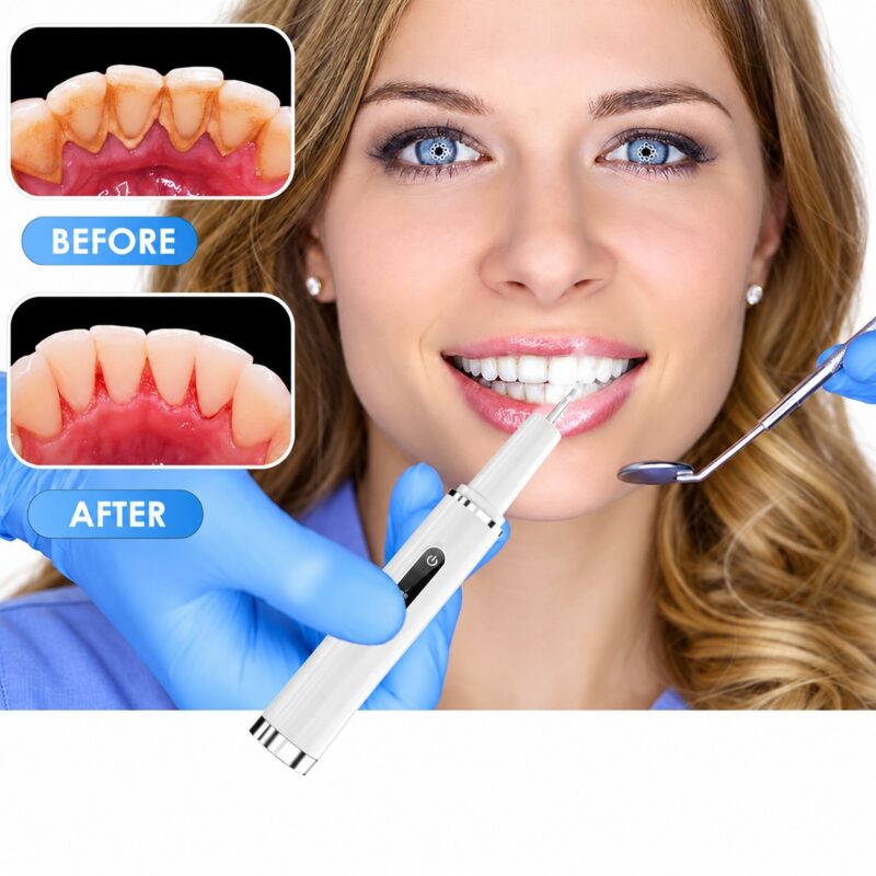 B2879cda 505d 4774 8dc8 057c26b4ba51 professional plaque remover contact activated teeth cleaning 11.jpg